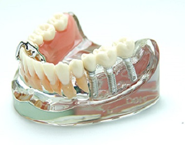 差し歯や入れ歯に変わる新しい噛める治療法